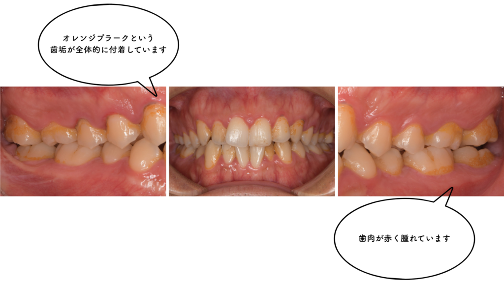 30代の歯周病