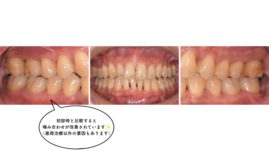 40代の歯周病