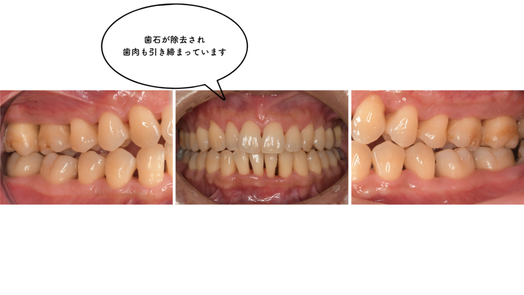 40代の歯周病