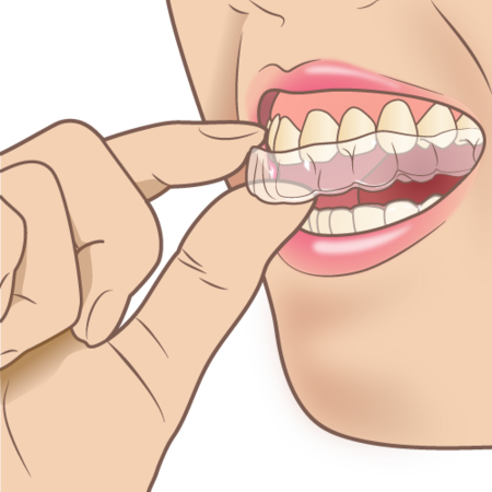mouthpiece_orthodontic.png